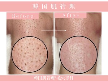 毛穴専科