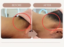 シルク(Cilk)/うなじ脱毛