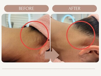 シルク(Cilk)/うなじ脱毛