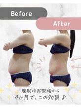 ミネット(minette)/脂肪冷却＊before→after