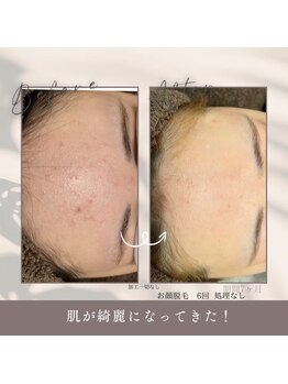 モアトゥインクル 福山宮通り店(MORE twinkle)の写真/*大好評*【お顔脱毛+毛穴洗浄+フェイシャルエステ¥9900】シミ/シワ/たるみ/肌トラブル改善!大満足美肌ケア*