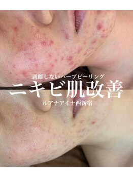 ルアナアイナ(Luana Aina)/ハーブピーリングでニキビケア