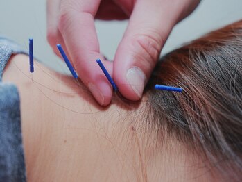 ハレルヤ鍼灸治療院/鍼施術