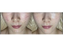 フィール(feel)/ビフォー　アフター　3回施術