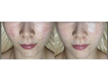 フィール(feel)/ビフォー アフター 3回施術