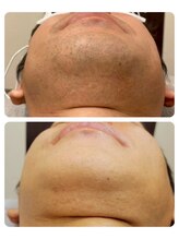 エアリアル 大牟田店/ヒゲ脱毛