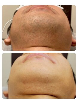 エアリアル 大牟田店/ヒゲ脱毛