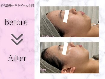 リライフ(ReLIFE)/韓国肌管理/毛穴洗浄+ララピール