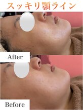 ミムー/before／after