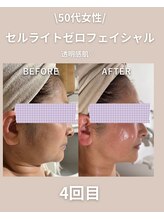 エン(enn.)/セルライトゼロ フェイシャル5回
