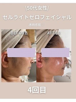 エン(enn.)/セルライトゼロ フェイシャル5回