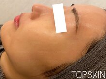 トップスキン 新宿(TOPSKIN)/肌荒れ・赤み・凹み改善
