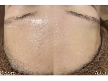 メルシア(merucia)/産毛毛穴撃退★ララピール×wax