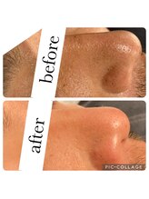 オゾンレメディ(O3remedy)/毛穴エクストラクション