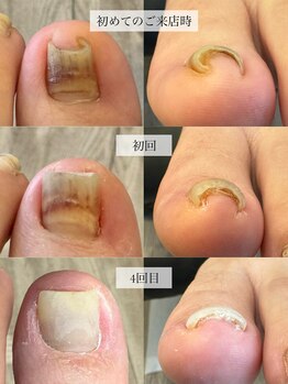 ネイルサロンクレール(CLAIR)/巻き爪補正