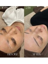 #美容革命ラボ 福岡春吉店/トーンアップ【天神春吉】