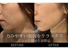 ハリーベージュ(Hariy Beige)の雰囲気（【人気No.1】圧倒的小顔美容鍼+オイルマッサージ ）