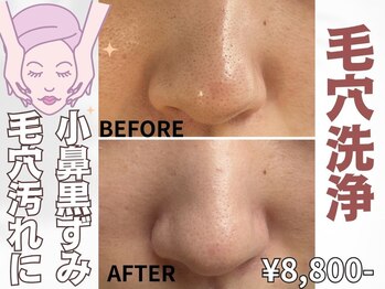 ページミュー/小鼻のザラつき・いちご鼻