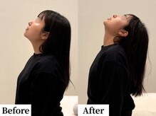 ソレア(Solea)/首こり・ストレートネック改善