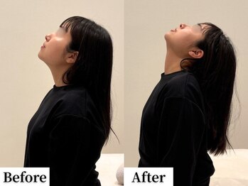 ソレア(Solea)/首こり・ストレートネック改善