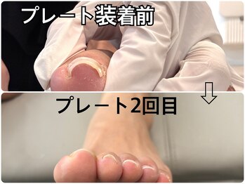 巻き爪　巻き爪補正