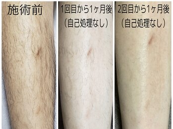 ヴァロ(Valo)/メンズ人気No.2ヒザ下脱毛