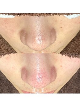 エクラ バイ シャンリィ(eclat by shanLy)/毛穴綺麗に