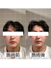 ヴィーライン 大阪梅田院(VeLine)/鍼灸／美容鍼／小顔／大阪／梅田