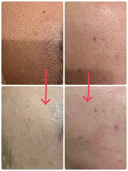 オリエンス(oriens)/【LED光脱毛】