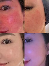 ローズ(ROSE)/before after