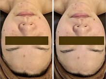 ナチュラーレ 京都四条烏丸店(Naturale)/美肌ニキビケア小顔フェイシャル