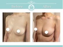 美人バスト 宇都宮店/☆バストアップ症例/育乳☆