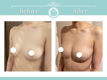 美人バスト 宇都宮店/☆バストアップ症例/育乳☆