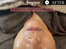 アングレイス(Anngrace)/【本気の肌質改善】圧倒的効果