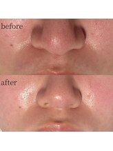 コモレビ(komorebi)/小鼻黒ずみ・毛穴改善♪