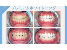 マイントゥー(mine too)の雰囲気（ハイトーンホワイトニングで清潔感溢れる白い歯に★セルフケア♪）