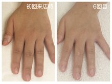 キレイテ 上野店/30代/6回目【ハンドケア上野】