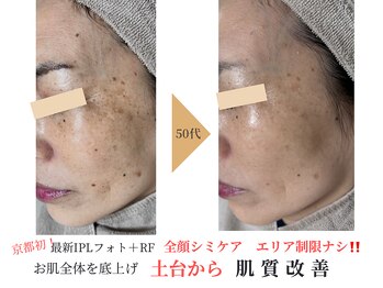 エソア(esoa)の写真/京都初導入!特許取得光フォトで"全顔シミ当て放題"エリアや時間制限ナシ!でお悩みに集中アプローチ