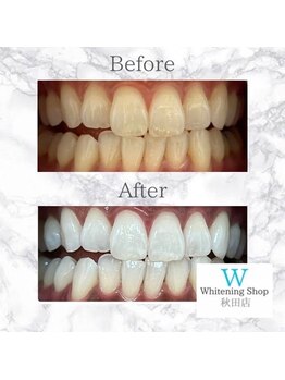 ホワイトニングショップ 秋田店/【before after】 美白