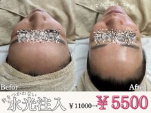 マヴィ 香里園店(MavY.)/ノンニードル水光注入