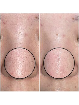 プレミア ボーテ (PREMIER BEAUTE)/毛穴ケア