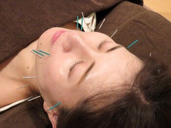 ティンクル(Twinkle)/美容鍼