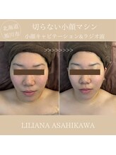 リリアーナ アサヒカワ(LILIANA ASAHIKAWA)/小顔キャビテーション