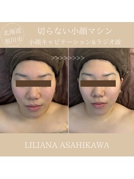 リリアーナ アサヒカワ(LILIANA ASAHIKAWA)/小顔キャビテーション