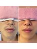 【メンズ】ヒゲ脱毛(剃刀負け/ニキビ/肌荒れ悩み解決)モテるイケメン肌へ改善