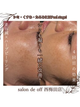 ハリサロンドオフ 西梅田店(hari salon de off)/シミケア ビフォーアフター