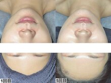 ハーブピーリング×韓国肌管理【&me恵比寿店】ピーリング/ララピール/毛穴ニキビケア/ララピール【艶肌/美白/くすみ】