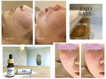 エモベーシック(e'MO BASIC)の雰囲気(光美容の最高峰『BBL』全顔約2700発の照射でお悩みを改善♪)