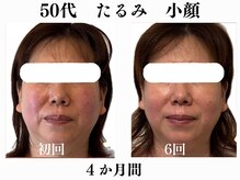 ランティル(l’until)の雰囲気（年齢を重ねたお顔の脂肪・二重あごに！老け顔→ハリのある小顔へ）