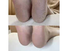 モカラ(mokara)/◇フット角質ケア◇